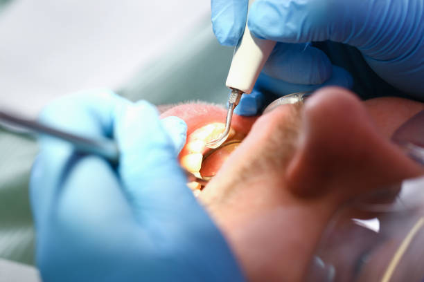 Best Emergency Dental Care for Broken or Chipped Teeth in Brookhaven, GA